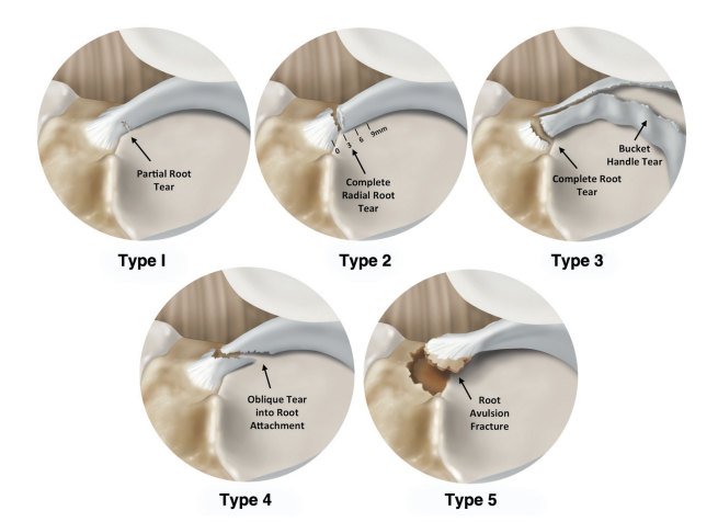 Clasificación de LaPrade de las roturas de la raíz meniscal en cinco tipos